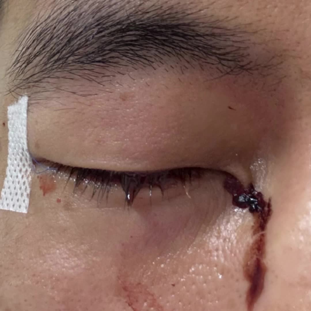 郭艾倫社媒曬受傷照片，看著真是觸目驚心?。? title=