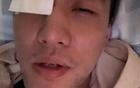 郭艾倫眼傷嚴重縫40針，疑慮復出。