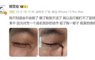 郭艾倫訓練傷眼，相關方需擔法律責任